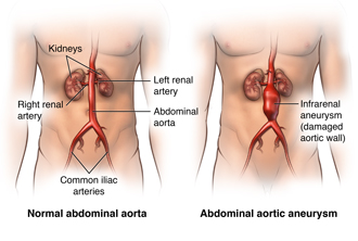 Abdominal Aortic Aneurysm Oothecae